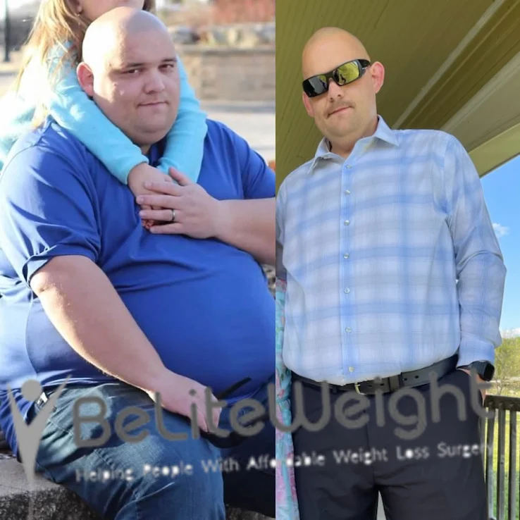 Weight Loss Surgery Before And After